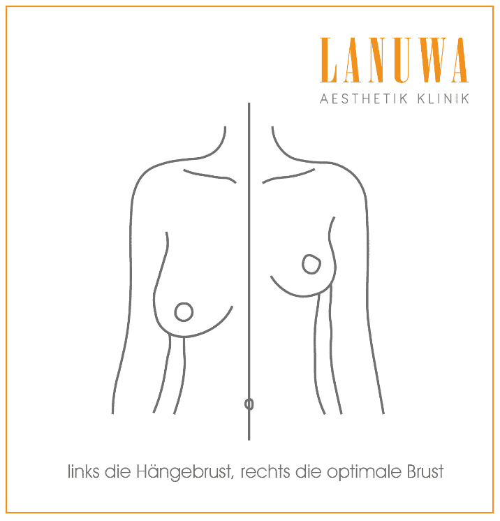 Links die Hängebrust, rechts die optimale Brust Schematische Darstellung: links Hängebrust, rechts optimale Brustform