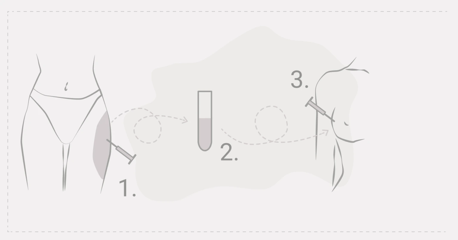 Lipofilling-Prozess: 1. Fettentnahme, 2. Aufbereitung, 3. Injektion in die Brust Lipofilling-Prozess: 1. Fettentnahme, 2. Aufbereitung, 3. Injektion in die Brust